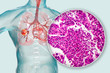 © Dr_Microbe - Lung cancer, 3D illustration and photo under microscope. Histopathology light micrograph