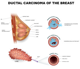 Ductal carcinoma of the breast, detailed medical illustration. Ductal cancer in situ and invasive ductal cancer cross section anatomy on a white background.