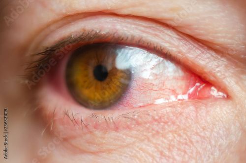 Fotografie, Obraz Closeup irritated infected red bloodshot eyes, conjunctivitis