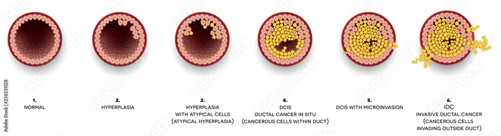 Breast cancer Ductal carcinoma of the breast. At the beginning normal ...