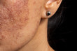 Age spots and increased skin pigmentation