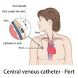 Port totally implantable venous access device. Medical poster

