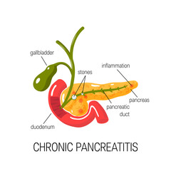 Wall Mural - Chronic pancreatitis concept. Vector illustration