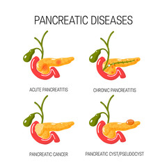 Wall Mural - Diseases of the pancreas concept. Vector illustration