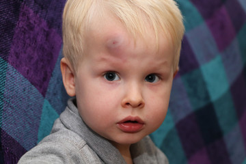 A big bruise on the forehead of a little boy