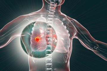 Wall Mural - Lung cancer, 3D illustration showing malignant tumour in the ung