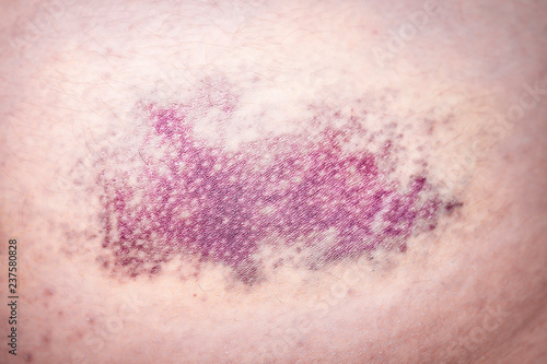 Fotografie, Obraz close up of bruise hit on the leg, hematoma
