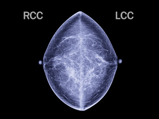 X-ray Digital Mammogram both side,mammography breast scan name is CC view.