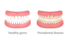 Dental concept, gum treatment. Gum disease and teeth, periodontal disease. Gum disease, bleeding gums, unhealthy teeth, yellow teeth, bad teeth. Vector illustration.