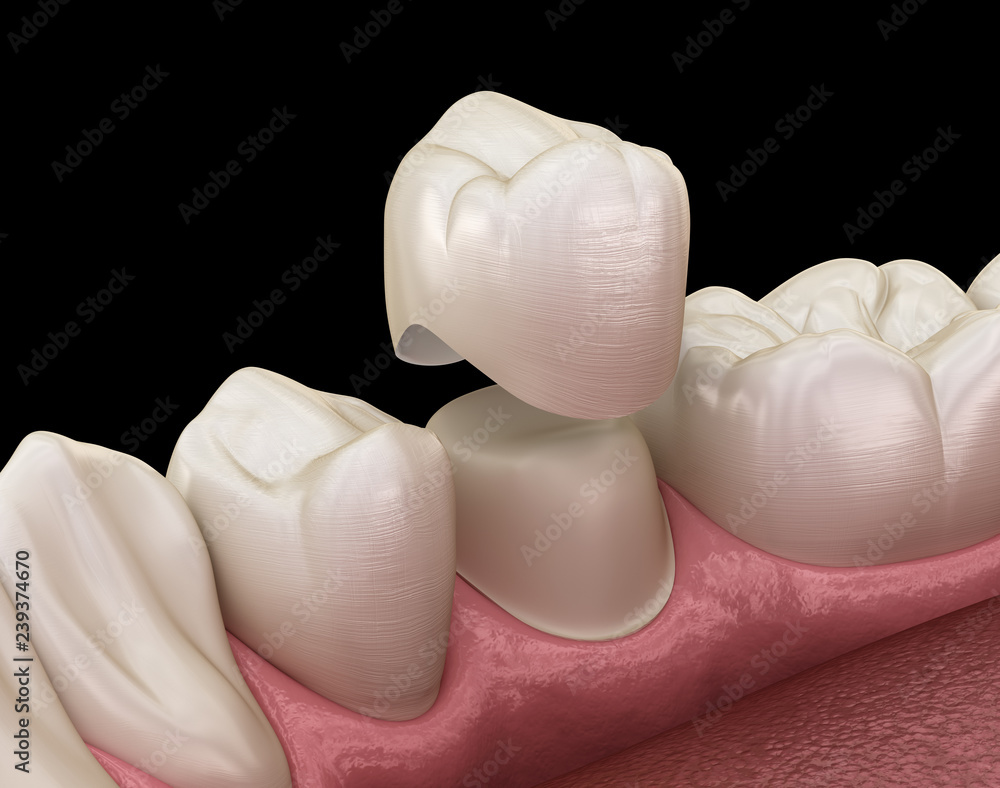 Dental crown premolar tooth assembly process. Medically accurate 3D illustration of human teeth treatment