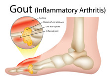 Gout (Inflammatory Arthritis) Gout Is An Intensely Painful Type Of Arthritis , Illustration - Vector