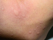© werafotolia - ill allergic rash dermatitis eczema skin texture.