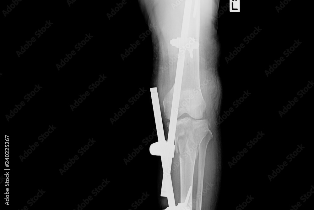 Photo Stock Show fracture tibia and fibula left lateral. X-ray image of ...