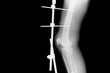 © Pattadis - Show fracture tibia and fibula left lateral. X-ray image of fracture leg with implant external fixation.