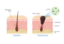 Bacteria In Blackhead With Human Skin Layer Structure And Healthy Skin. Illustration About Dermatology Diagram .