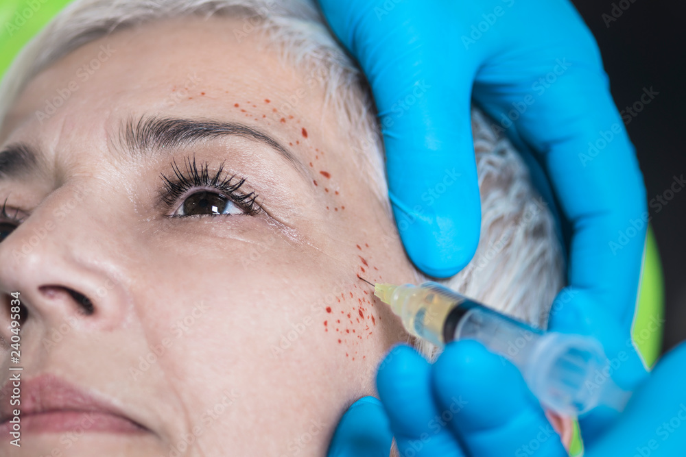 Prp Injection Full Face PRP Face Injecting Treatment. Cosmetic Anti-Aging Platelet Rich Plasma ...