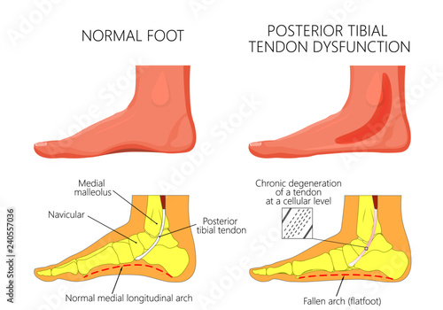 Vector Illustration Of Healthy Human Foot And A Medial Ankle