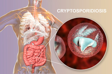 Canvas Print - Cryptosporidiosis, a diarrheal disease caused by Cryptosporidium parvum protozoan. 3D illustration showing release of parasite sporozoites from oocyst inside small intestine