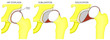 © Aksana - Vector illustration anatomy of a hip joint with dysplasia, subluxation and dislocation of the femoral head in the joint . Front view. For advertising and medical publications.