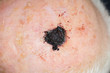 Malignant melanoma on the head of an old caucasian man