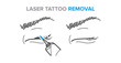 Eyeliner removal procedure, laser tattoo removal icons, microblading