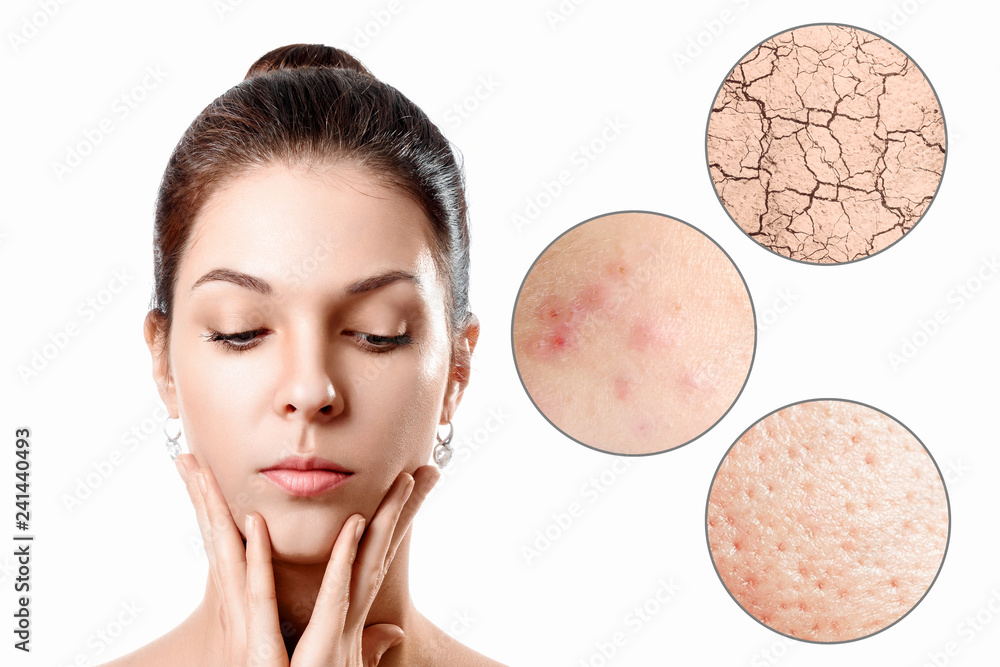 Young woman with acne, dry skin, black dots skin in zoom circle . Skin care concept. Young girl, beauty portrait. Close-up. - obrazy, fototapety, plakaty 