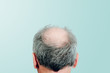 Rear view of a male head without hair on blue pastel background. Hair loss concept, bird's nest on the head. Problems with hair regrowth, shampoo for facial hair growth.
