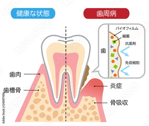 健康な歯と歯周病 バイオフィルム 断面図 Stock Vector Adobe Stock 健康な歯と歯周病 バイオフィルム 断面図 Stock Vector Adobe Stock