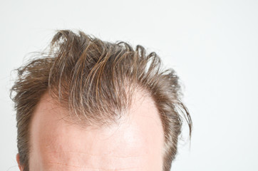 Hair loss man