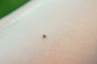 Tick crawling on the skin. The concept of danger of encephalitis and tick bite.