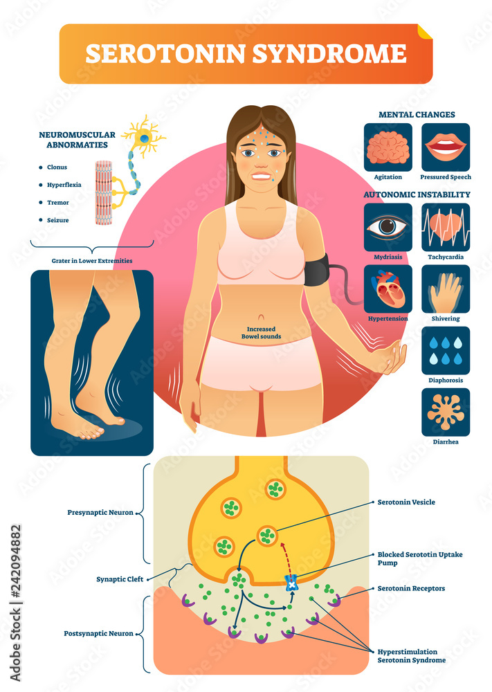 Serotonin syndrome vector illustration with medical labeled symptoms scheme