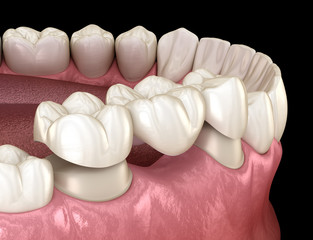 Dental bridge of 3 teeth over molar and premolar. Medically accurate 3D illustration of human teeth treatment