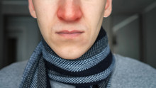 Unrecognizable Sick Guy In Warm Scarf With A Red Nose