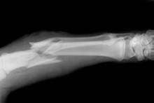 Broken Bone X-Ray 