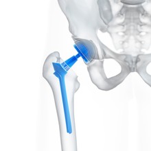 Illustration Of A Hip Replacement