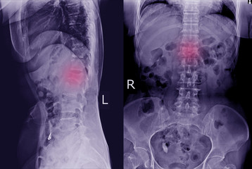 Naklejka na meble X-ray L-S Spine AP LATERAL: Finding Moderate compression fracture of L1 vertebra.