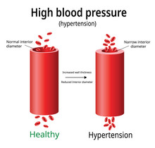 Hypertension, high blood pressure vector, two blood vessels, science and medical use, Vector Illustration