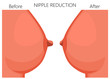 Vector illustration of the nipple reduction before and after plastic surgery. Side view of the woman breast. For advertising and medical publications