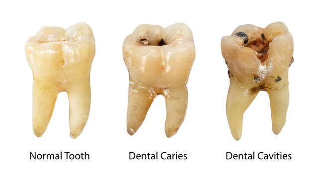 Fototapete - Normal tooth , Dental caries and Dental cavity with calculus . Comparison between difference of teeth decay stages . White isolated background . Front side view