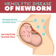Hemolytic disease of newborn infographics. Detailed vector Infographic. Baby Health