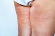 © NVB Stocker - Skin rash in the legs