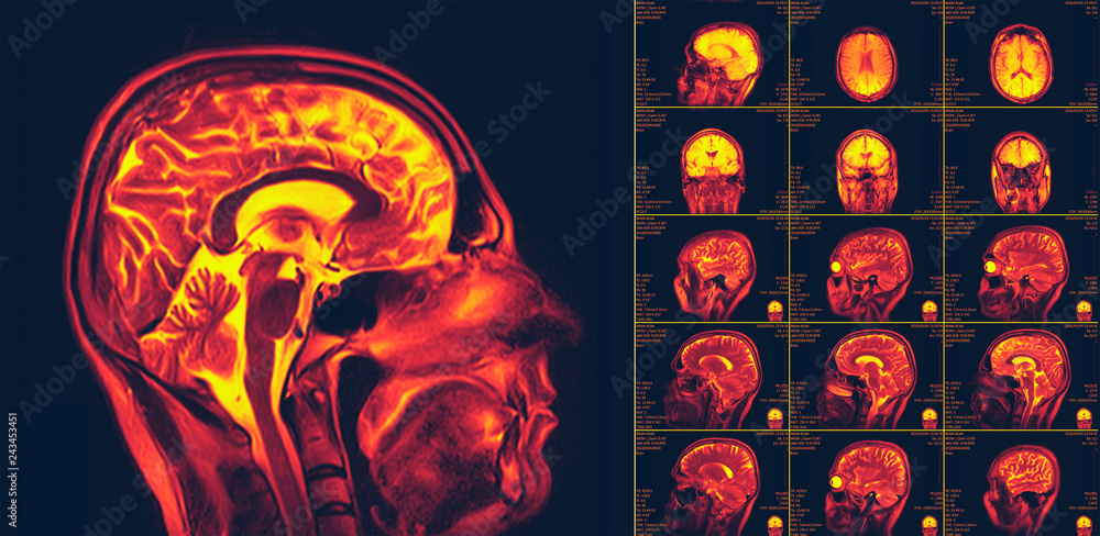 Magnetic resonance imaging of the brain. MRI scan Stock Photo | Adobe Stock