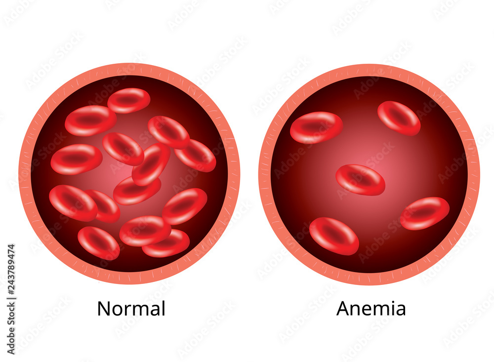 Infographic image, Blood of healthy human and blood vessel with anemia ...