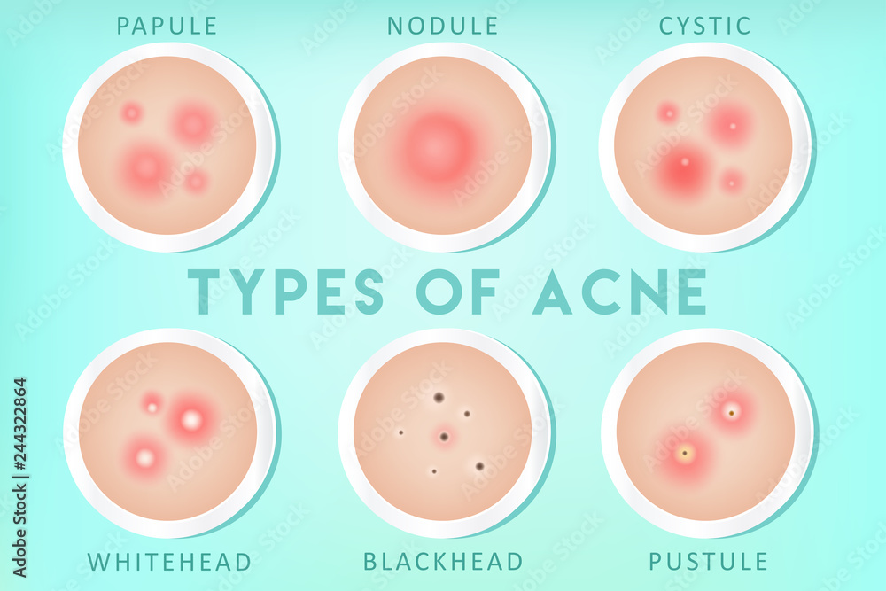 Acne types: whiteheads, blackheads, pustules, papules, cysts, nodules ...