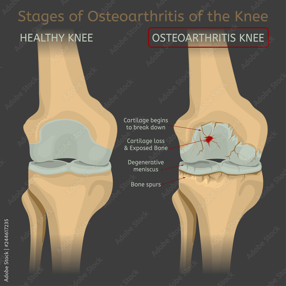 Stages of osteoarthritis of the knee Stock Vector | Adobe Stock