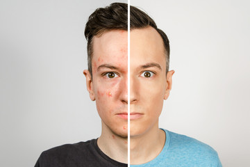 two guys before-after: left guy with acne, red spots, problem skin, right guy with healthy skin. Acne treatment concept