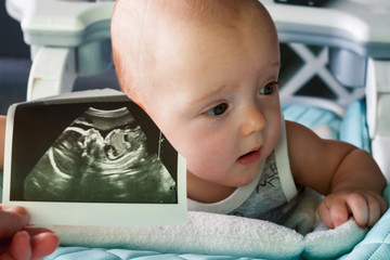 Ultrasound image at the 20th week of pregnancy in the foreground. In the background is a 6 month old baby. Before and now. Selective focus.