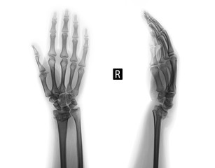 Wall Mural - X-ray of the wrist joint. Fracture of the radius. Negative.