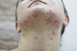 Allergy concept,young girl with problematic pimple on the face.-image.