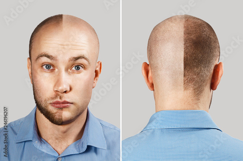 Two Serious Man Before And After Hair Loss Transplant On
